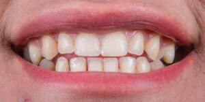 teeth whitening