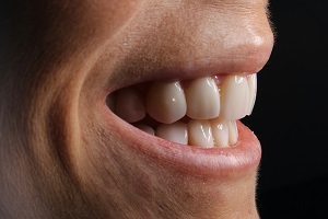 Common Treatments Included in a Full Mouth Restoration