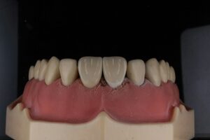 What Happens If You Delay Getting a Dental Crown